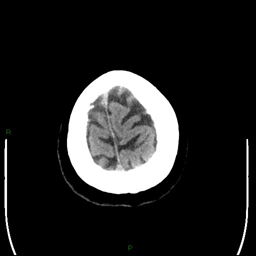 Cerebellar abscess (Radiopaedia 78135-90671 Axial non-contrast 103).jpg