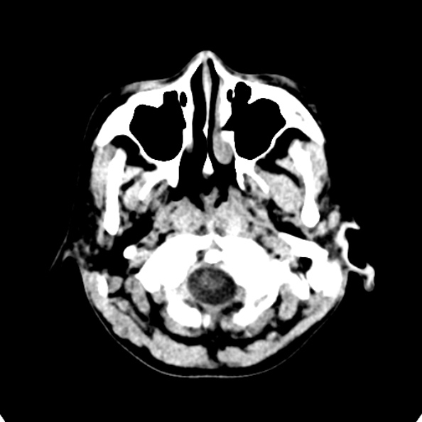 Cerebellar abscess secondary to mastoiditis (Radiopaedia 26284-26412 Axial non-contrast 9).jpg