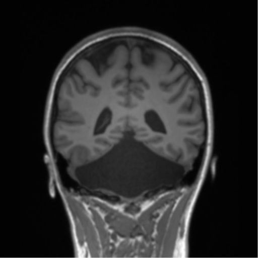 Cerebellar agenesis with hypoplastic pons (pontocerebellar hypoplasia) (Radiopaedia 57224-64138 Coronal T1 33).png