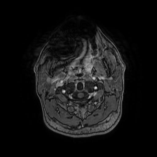 File:Cerebellar hemangioblastoma (Radiopaedia 88055-104622 Axial T1 C+ 9).jpg