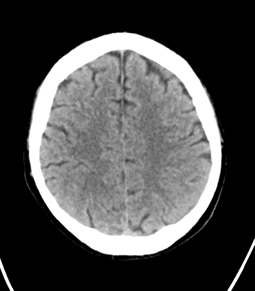 File:Cerebellar hemorrhage (Radiopaedia 37000-38669 Axial non-contrast 29).png