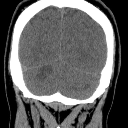 Cerebellar infarction (Radiopaedia 16625-16327 Coronal non-contrast 35).jpg