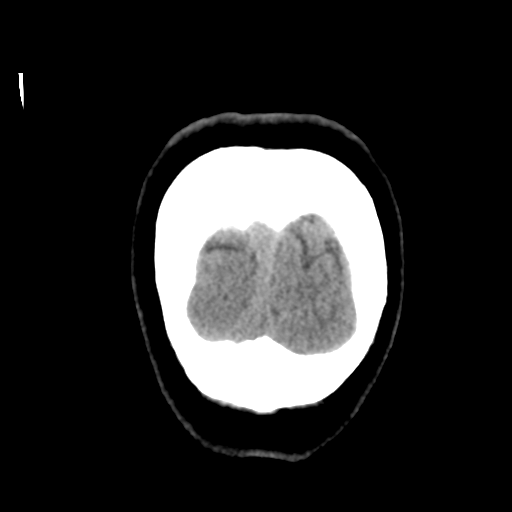 Cerebellar metastasis (cystic appearance) (Radiopaedia 41395-44258 Coronal non-contrast 58).png