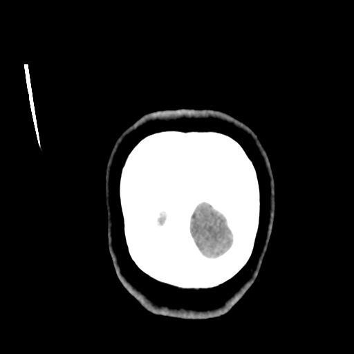 Cerebellar metastasis (cystic appearance) (Radiopaedia 41395-44258 D 60).png