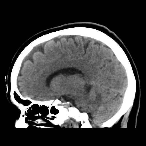Cerebellar metastasis (cystic appearance) (Radiopaedia 41395-44258 E 26).png