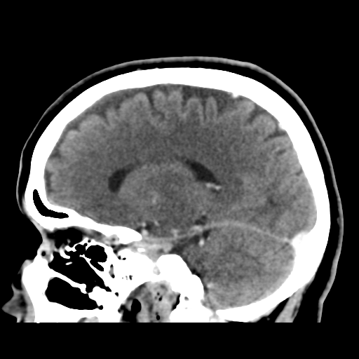 File:Cerebellar metastasis (cystic appearance) (Radiopaedia 41395-44258 F 22).png