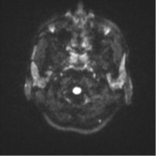 Cerebellar metastasis - adenocarcinoma lung (Radiopaedia 63184-71715 Axial DWI 29).png