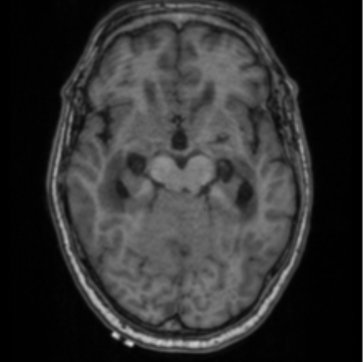 Cerebellar metastasis from lung adenocarcinoma (Radiopaedia 86690-102829 Axial T1 35).png