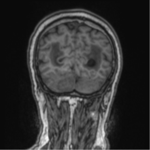 Cerebellar metastasis from lung adenocarcinoma (Radiopaedia 86690-102829 Coronal T1 20).png