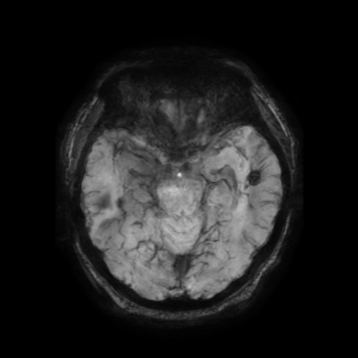 Cerebellar metastasis of pulmonary adenocarcinoma, cavernous venous malformation, and developmental venous anomaly (Radiopaedia 85827-101661 Axial SWI 44).jpg