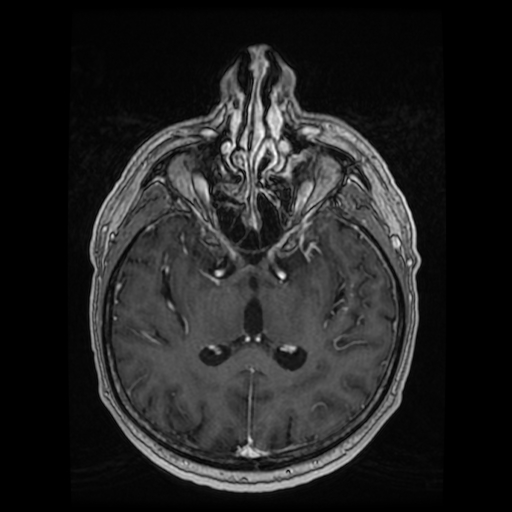 Cerebellar metastasis of pulmonary adenocarcinoma, cavernous venous malformation, and developmental venous anomaly (Radiopaedia 85827-101661 Axial T1 C+ 50).jpg