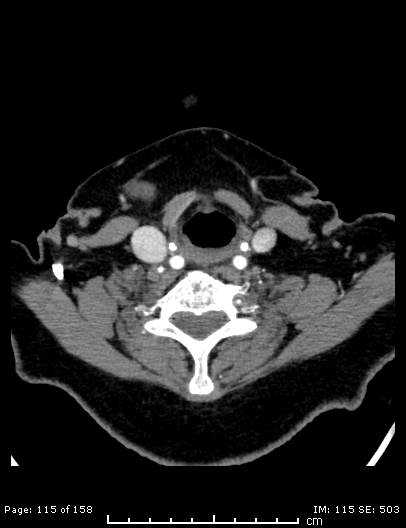 Cerebellar strokes due to intracranial giant cell arteritis (Radiopaedia 68799-78510 CT angiogram 115).jpg