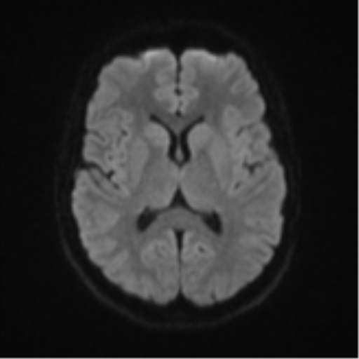 Cerebellar tuberculomas (Radiopaedia 46939-51472 Axial DWI 44).png
