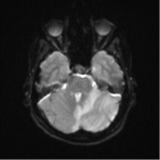 Cerebellar tuberculomas (Radiopaedia 46939-51472 Axial DWI 9).png