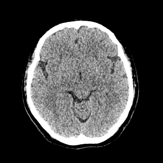 Cerebellopontine angle meningioma (Radiopaedia 53561-59592 Axial non-contrast 30).jpg