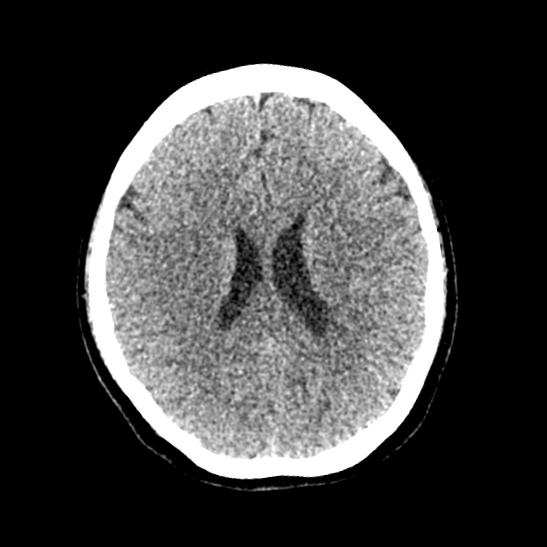 File:Cerebellopontine angle meningioma (Radiopaedia 53561-59592 Axial non-contrast 42).jpg