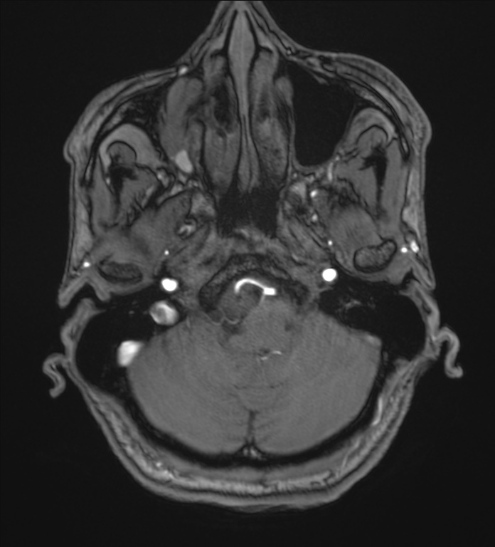 Cerebellopontine angle meningioma (Radiopaedia 72983-83680 Axial MRA 15).jpg