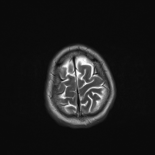 Cerebral abscess (Radiopaedia 26111-26247 Axial T2 52).jpg