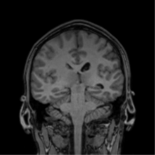 Cerebral abscess (Radiopaedia 60342-68009 Coronal T1 19).png