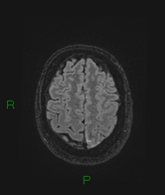 Cerebral abscess and subdural empyema (Radiopaedia 84436-99779 Axial FLAIR 20).jpg