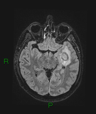 File:Cerebral abscess and subdural empyema (Radiopaedia 84436-99779 Axial FLAIR 49).jpg