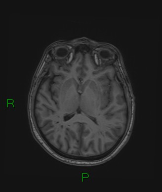Cerebral abscess and subdural empyema (Radiopaedia 84436-99779 Axial T1 42).jpg