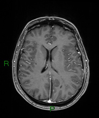 Cerebral abscess and subdural empyema (Radiopaedia 84436-99779 Axial T1 C+ 37).jpg