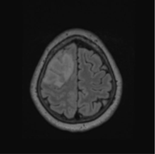 Cerebral abscess from pulmonary arteriovenous malformation (Radiopaedia 86275-102291 J 62).png