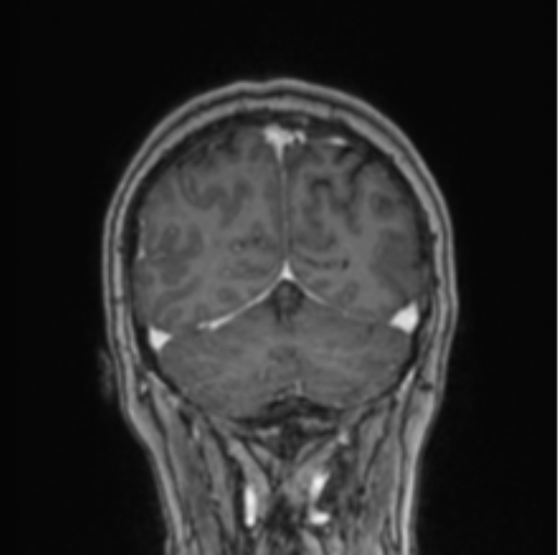 Cerebral abscess from pulmonary arteriovenous malformation (Radiopaedia 86275-102291 L 23).png