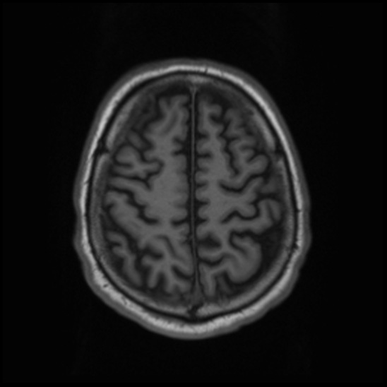 File:Cerebral abscess with ventriculitis (Radiopaedia 78965-91878 Axial T1 40).jpg