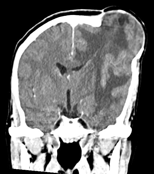 Cerebral abscesses (Radiopaedia 70458-80568 Coronal Contrast 32).jpg