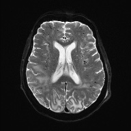 Cerebral amyloid angiopathy-related inflammation (Radiopaedia 74836-85849 Axial DWI 18).jpg
