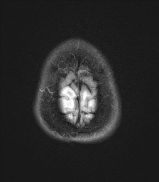 File:Cerebral amyloid angiopathy-related inflammation (Radiopaedia 74836-85849 Axial FLAIR 28).jpg