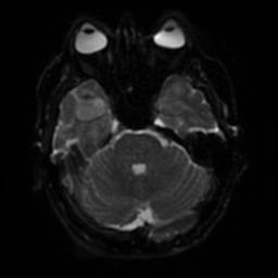 File:Cerebral amyloid angiopathy (Radiopaedia 28698-28978 Axial DWI 36).jpg