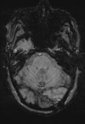 File:Cerebral amyloid angiopathy (Radiopaedia 29129-29518 Axial SWI MPR 9).jpg