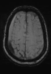 File:Cerebral amyloid angiopathy (Radiopaedia 29129-29518 Axial SWI Magnitude 28).jpg
