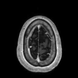 Cerebral amyloid angiopathy (Radiopaedia 29129-29518 Axial T1 C+ 135).jpg
