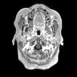 File:Cerebral amyloid angiopathy (Radiopaedia 29129-29518 Axial T1 C+ 14).jpg