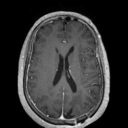 File:Cerebral amyloid angiopathy (Radiopaedia 29129-29518 Axial T1 C+ 91).jpg