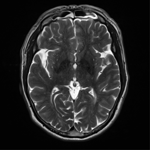 File:Cerebral amyloid angiopathy (Radiopaedia 46082-50433 Axial T2 18).png