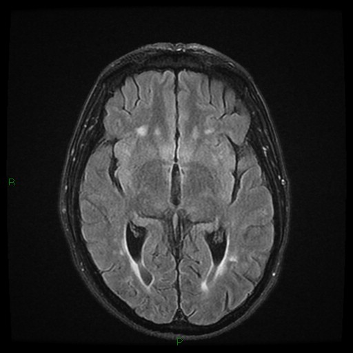 File:Cerebral amyloid angiopathy (Radiopaedia 77506-89664 Axial FLAIR 14).jpg