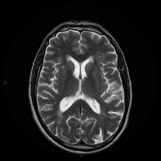 File:Cerebral amyloid angiopathy (Radiopaedia 77506-89664 Axial T2 16).jpg