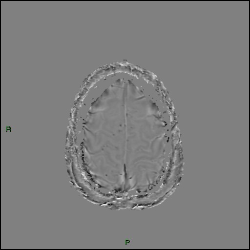 Cerebral amyloid angiopathy (Radiopaedia 77506-89664 H 90).jpg