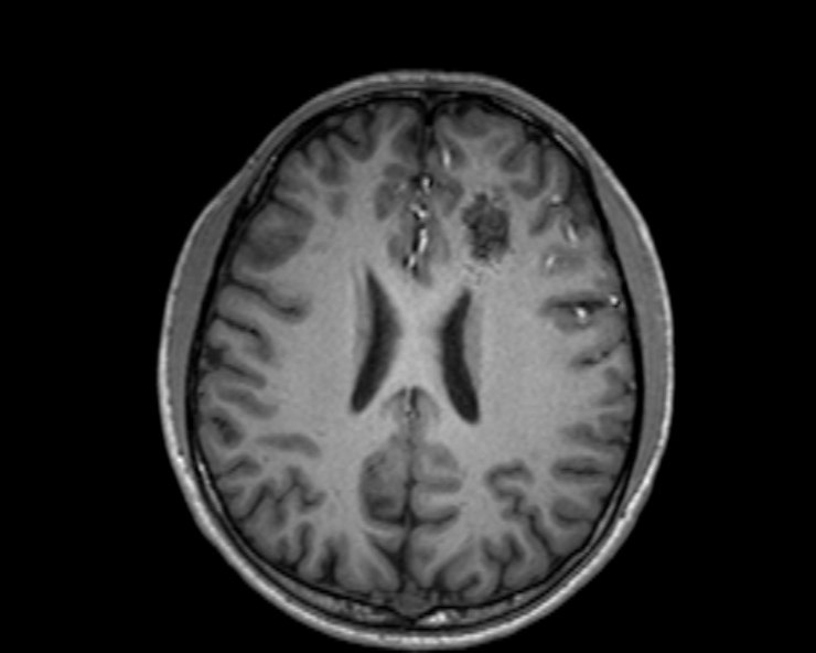 Cerebral arteriovenous malformation (Radiopaedia 30198-30813 Axial T1 27).jpg