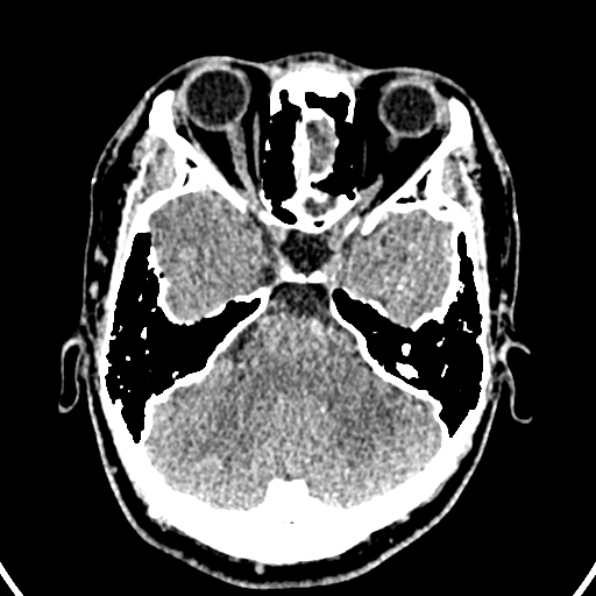 Cerebral arteriovenous malformation (Radiopaedia 37182-39012 Axial non-contrast 12).jpg
