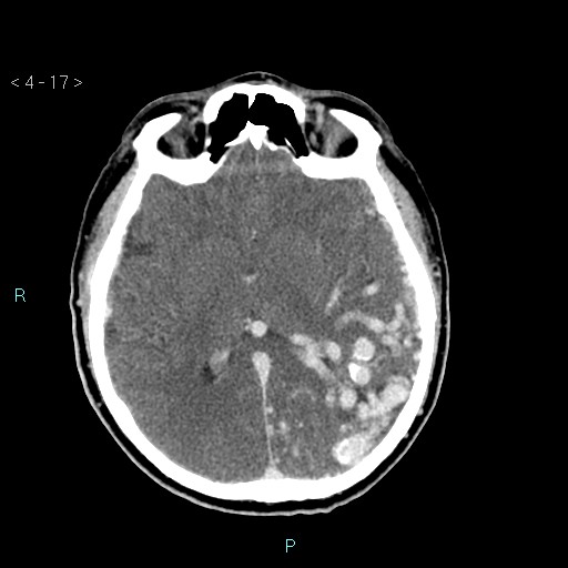 File:Cerebral arteriovenous malformation (Radiopaedia 40528-43125 Axial C+ delayed 17).jpg