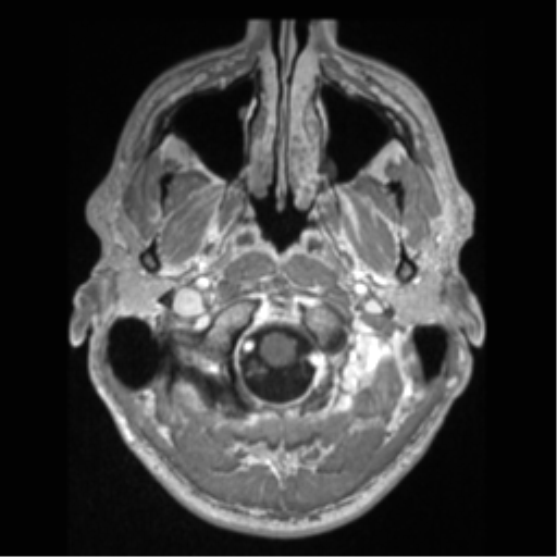 Cerebral arteriovenous malformation (Radiopaedia 55798-62372 Axial T1 C+ 4).png