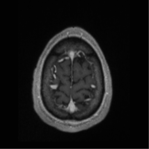 Cerebral arteriovenous malformation (Radiopaedia 55798-62372 Axial T1 C+ 70).png