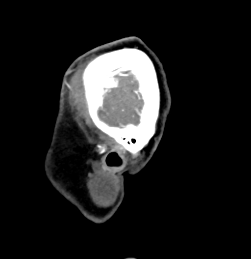 Cerebral arteriovenous malformation (Radiopaedia 73830-84645 D 87).jpg