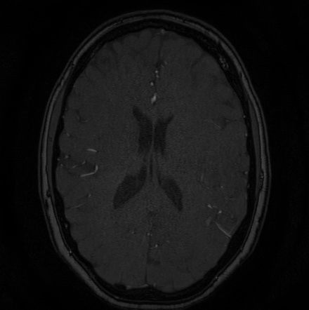 Cerebral arteriovenous malformation (Radiopaedia 74411-85654 Axial MRA 93).jpg